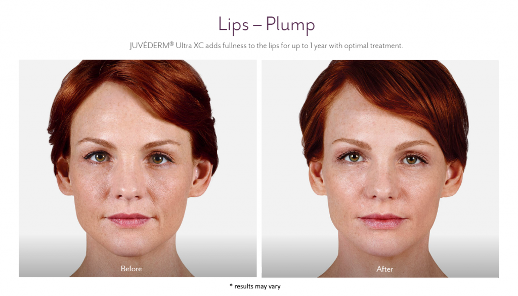 Before and after Juvederm injections