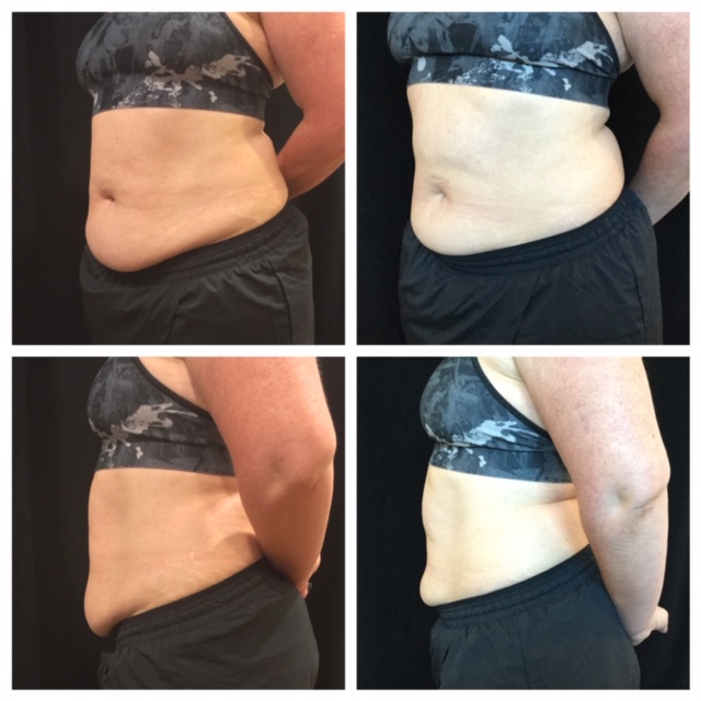 Before and after CoolSculpting results